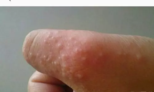 痛苦!手上突然起這種「小水泡」,很癢,抓破後有少量液體流出,該怎麼辦?教你一招,很快就好!