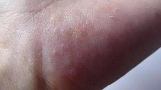 痛苦!手上突然起這種「小水泡」,很癢,抓破後有少量液體流出,該怎麼辦?教你一招,很快就好!