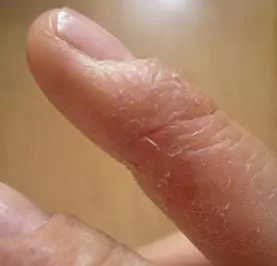 痛苦!手上突然起這種「小水泡」,很癢,抓破後有少量液體流出,該怎麼辦?教你一招,很快就好!