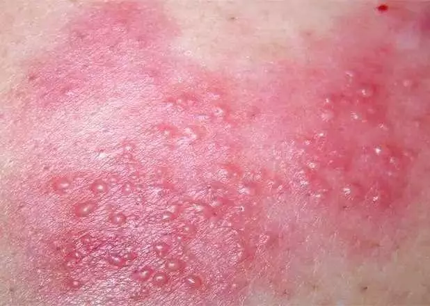 痛苦!手上突然起這種「小水泡」,很癢,抓破後有少量液體流出,該怎麼辦?教你一招,很快就好!