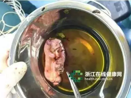 女子體內取出大量黑蟲,與「這個愛好」有關沒想到「這些東西」大家都在吃