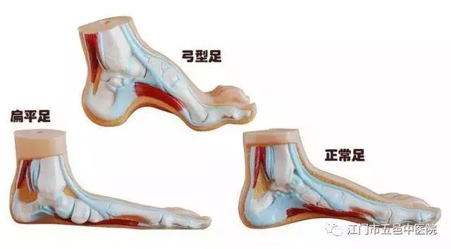 走路腳跟疼,像踩到釘子一樣?這病惹禍,簡單四招幫你遠離疼痛