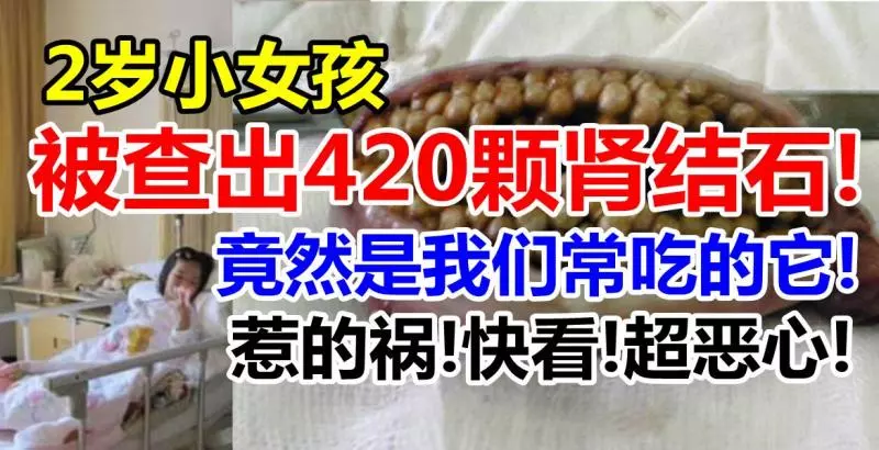 2歲小女孩被查出420顆腎結石!竟然是我們常吃的它!惹的禍!不可忽視!