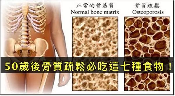 50歲後骨質...預防骨質疏鬆必吃「七種高鈣食物」:專補骨頭空洞,輕鬆恢復好骨力!