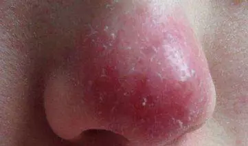 請注意發現肝病前,身體會出現容易辨認的徵兆,一旦出現請到醫院檢查