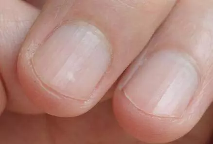 請注意發現肝病前,身體會出現容易辨認的徵兆,一旦出現請到醫院檢查