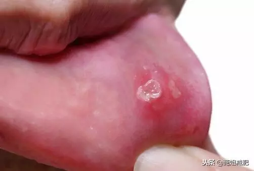 口腔潰瘍總是反覆,需警惕5種疾病,別不當回事