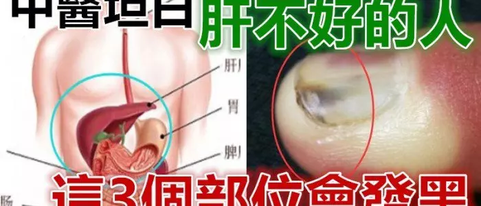 中醫坦白:肝不好的人,這3個部位會發黑!秋季多吃3種改善肝功能的食物