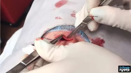 男子6年長成「獨角獸巨痘」!醫生一刀劃開皮膚「輕輕一壓膿包爆出....」宛如起司驚動全球網友!