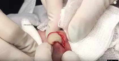 男子6年長成「獨角獸巨痘」!醫生一刀劃開皮膚「輕輕一壓膿包爆出....」宛如起司驚動全球網友!