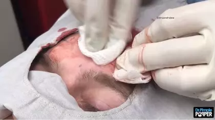 男子6年長成「獨角獸巨痘」!醫生一刀劃開皮膚「輕輕一壓膿包爆出....」宛如起司驚動全球網友!