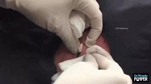 男子6年長成「獨角獸巨痘」!醫生一刀劃開皮膚「輕輕一壓膿包爆出....」宛如起司驚動全球網友!
