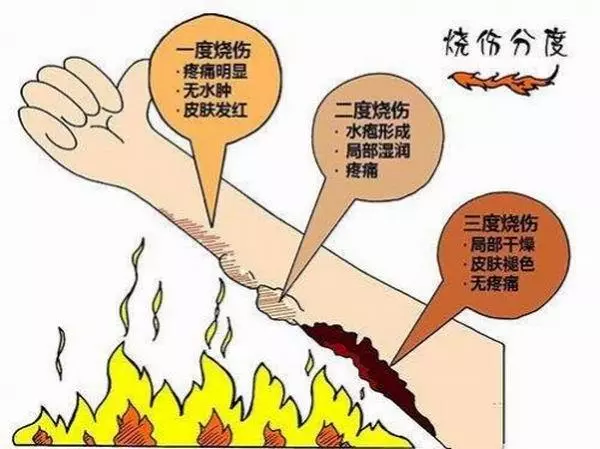 兒童燙傷、劃傷、扭傷、流鼻血的急救處理誤區