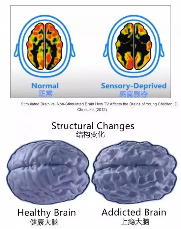 孩子經常「看電視、玩手機」會有什麼後果?來看一張大腦萎縮圖,英國科學家用事實說話