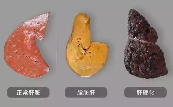 喜歡喝酒的人,晚上睡覺若沒有這4種症狀,恭喜你,肝臟比較健康!