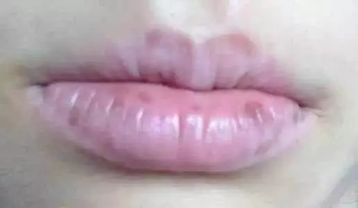 心臟不好的人,臉上會有這4種表現,趕緊去檢查吧!