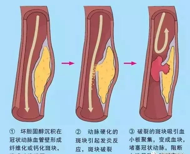 心肌梗塞急救法(搶救黃金30秒),關鍵時刻,能救自己一命,也為家人收好