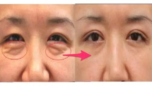 好神奇!三分鐘後眼袋 、魚尾紋全消失了!居然只要在水裡加入(這個東西)