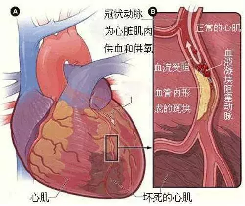 急性胸痛鑑別非常重要,三種極易致死的胸痛該如何鑑別
