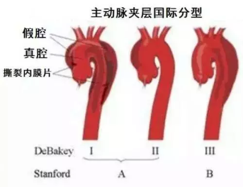 急性胸痛鑑別非常重要,三種極易致死的胸痛該如何鑑別