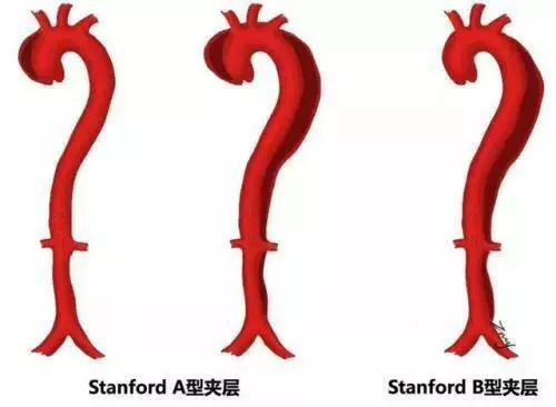 急性胸痛鑑別非常重要,三種極易致死的胸痛該如何鑑別