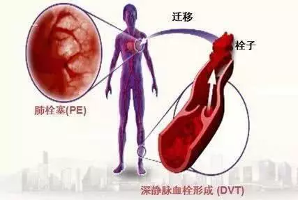 急性胸痛鑑別非常重要,三種極易致死的胸痛該如何鑑別