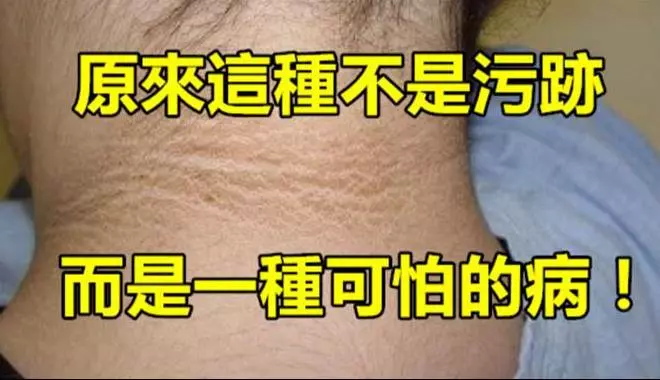 女孩脖子上有一圈洗不掉的髒汙,去檢查時醫生的話嚇壞了大家,紛紛檢查自己有沒有!