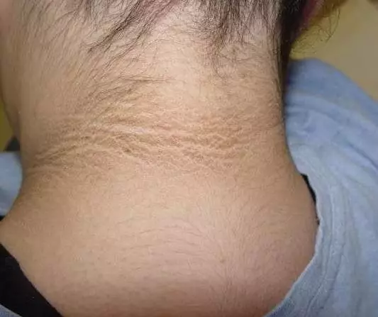 女孩脖子上有一圈洗不掉的髒汙,去檢查時醫生的話嚇壞了大家,紛紛檢查自己有沒有!