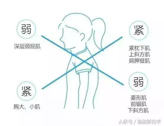 圓肩駝背頭前傾,這是上交叉綜合徵,這樣來調整!