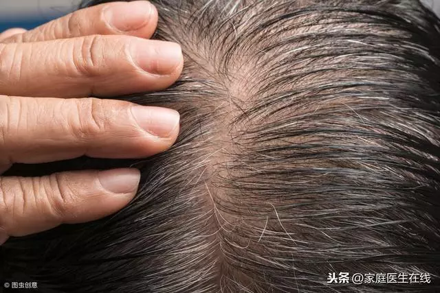 男性為什麼容易脫髮?主要是這幾個原因!