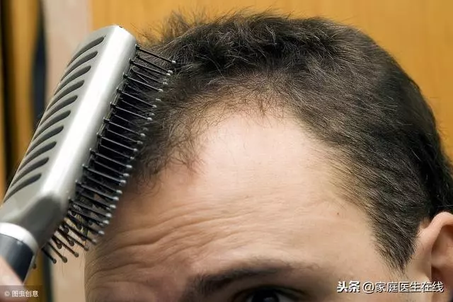 男性為什麼容易脫髮?主要是這幾個原因!