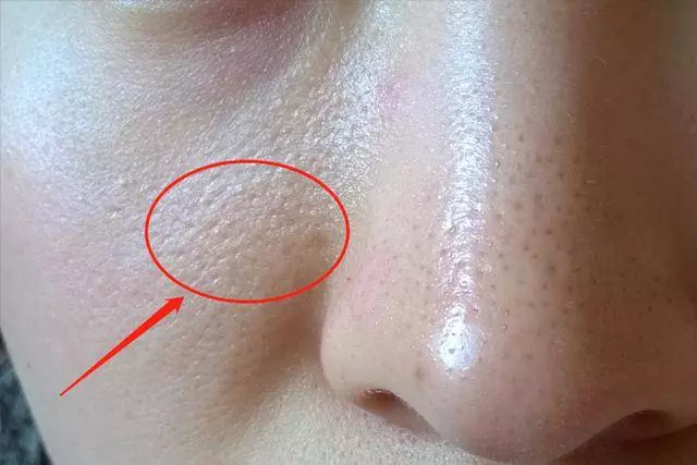 肝不好,【解毒功能】下降 !臉上會有4個「變化」 ,1個沒有,恭喜你,肝很健康