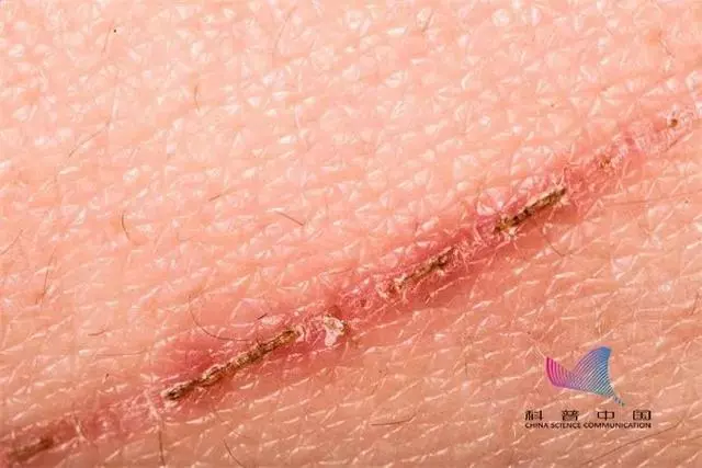 好好的皮膚,為啥會留疤?它為保護你,簡直操碎了心