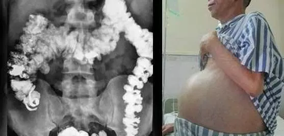 肚腩的贅肉是由於發胖所致,其實,那是結腸 內的毒素大量積結