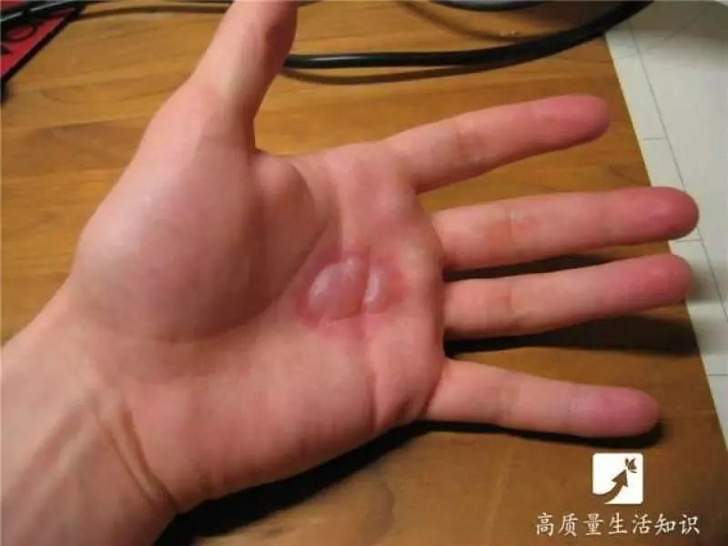被燙傷了別急,教你正確的解決方法