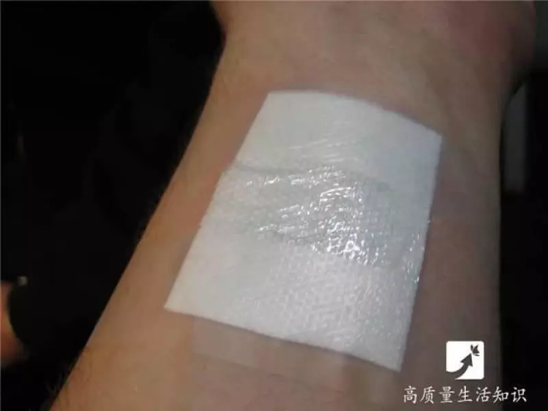 被燙傷了別急,教你正確的解決方法