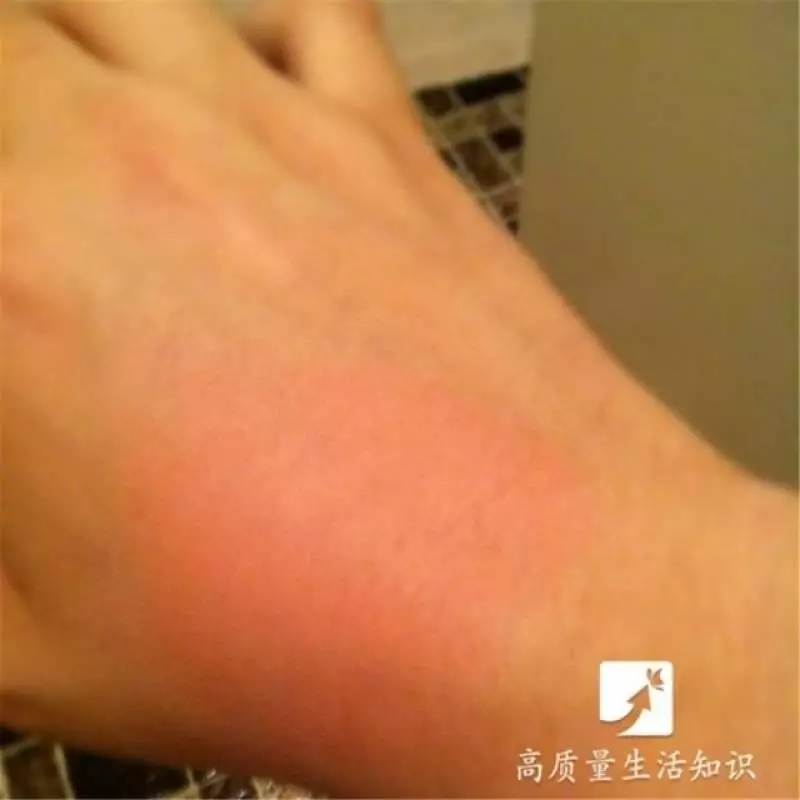 被燙傷了別急,教你正確的解決方法