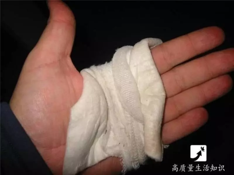 被燙傷了別急,教你正確的解決方法