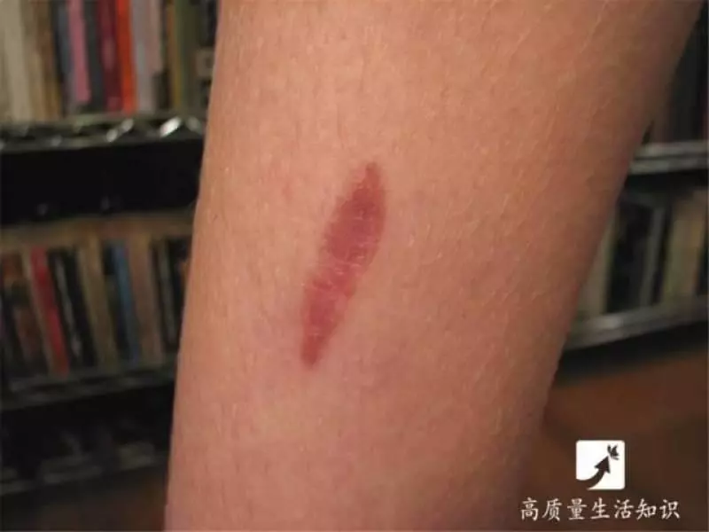 被燙傷了別急,教你正確的解決方法