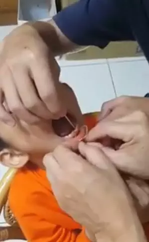 小時候的回憶~男孩給家人用繩子拔牙 牙齒瞬間掉!可是額頭爆了XD