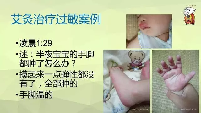 如何用艾灸調理鼻炎、寒性便秘、咳嗽、哮喘、過敏體質