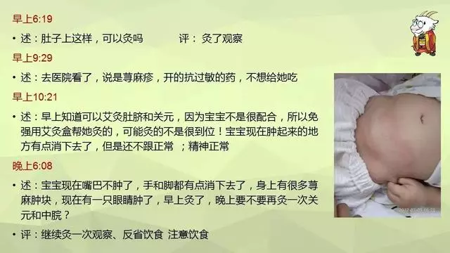 如何用艾灸調理鼻炎、寒性便秘、咳嗽、哮喘、過敏體質