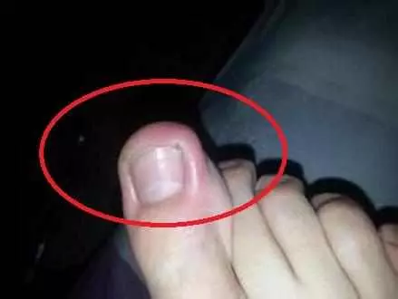 「腎」不好腳知道,如果腳上沒有這4個表現,恭喜!你的腎很健康