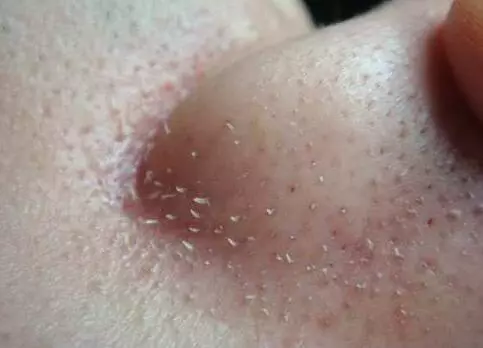 女人皮膚這樣就是有蟎蟲,很多人不知道,教你一招,去蟎蟲更健康