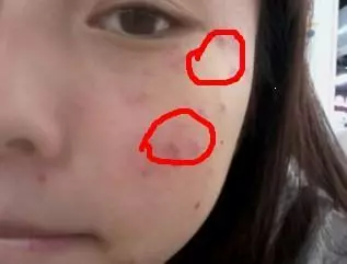 女人皮膚這樣就是有蟎蟲,很多人不知道,教你一招,去蟎蟲更健康