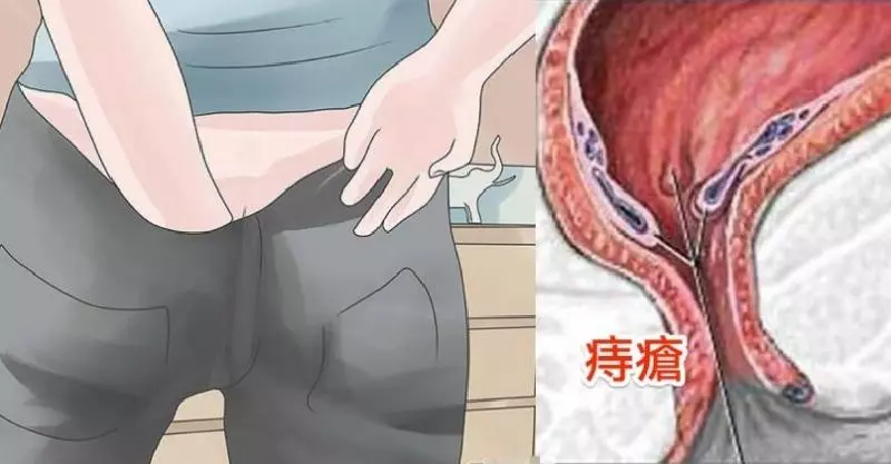 常言道「十人九痔」,「十男九痔,十女十痔」,又有「十痔九不醫」的說法。教你兩種方法自然根除「痔瘡」,人人都不再癢!只要簡