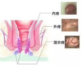 常言道「十人九痔」,「十男九痔,十女十痔」,又有「十痔九不醫」的說法。教你兩種方法自然根除「痔瘡」,人人都不再癢!只要簡
