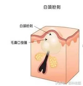 下巴上長出許多白色的小點點,是怎麼回事兒?該怎麼處理呢?