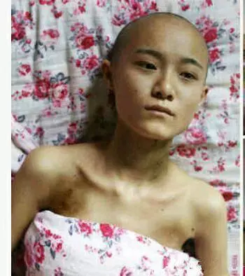 23歲胃癌晚期,醫生說天天吃這三樣誰都容易患癌!