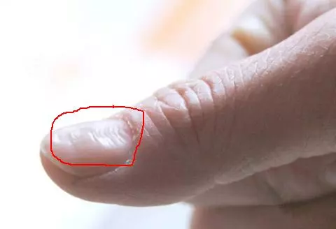 指甲出現這五個狀況不要忽視,可能是大病的預兆
